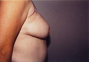 Breast Reconstruction 2d
